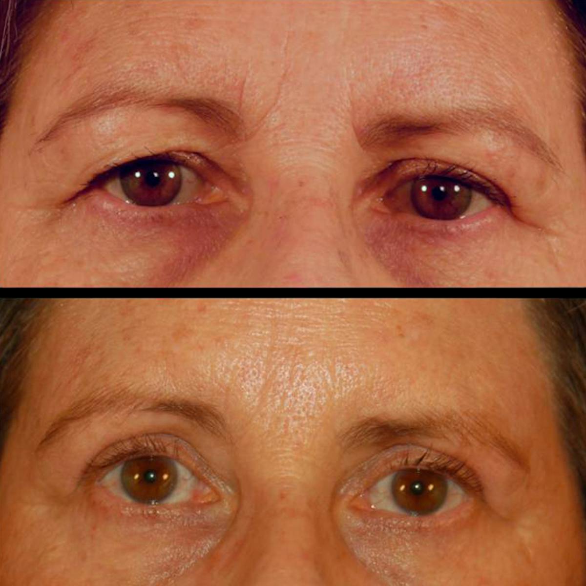 Upper Eyelid Surgery Before & After Gallery - Patient 816568 - Image 2