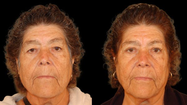 Upper Eyelid Surgery Before & After Gallery - Patient 159746 - Image 1