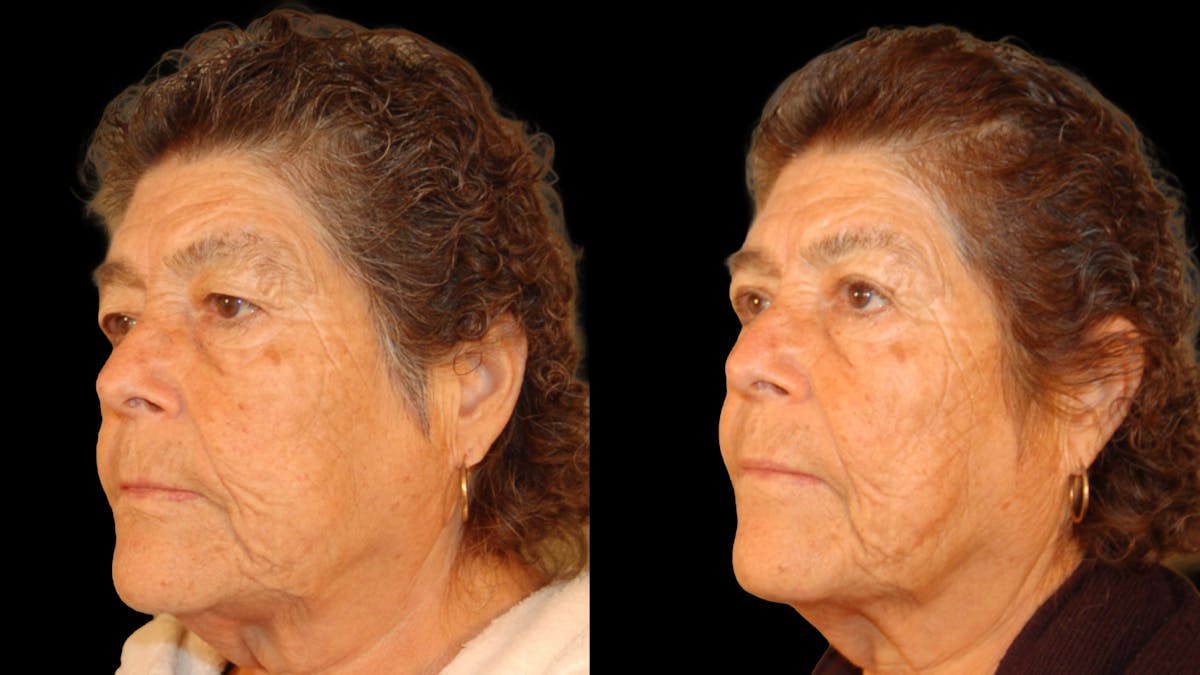 Upper Eyelid Surgery Before & After Gallery - Patient 159746 - Image 2