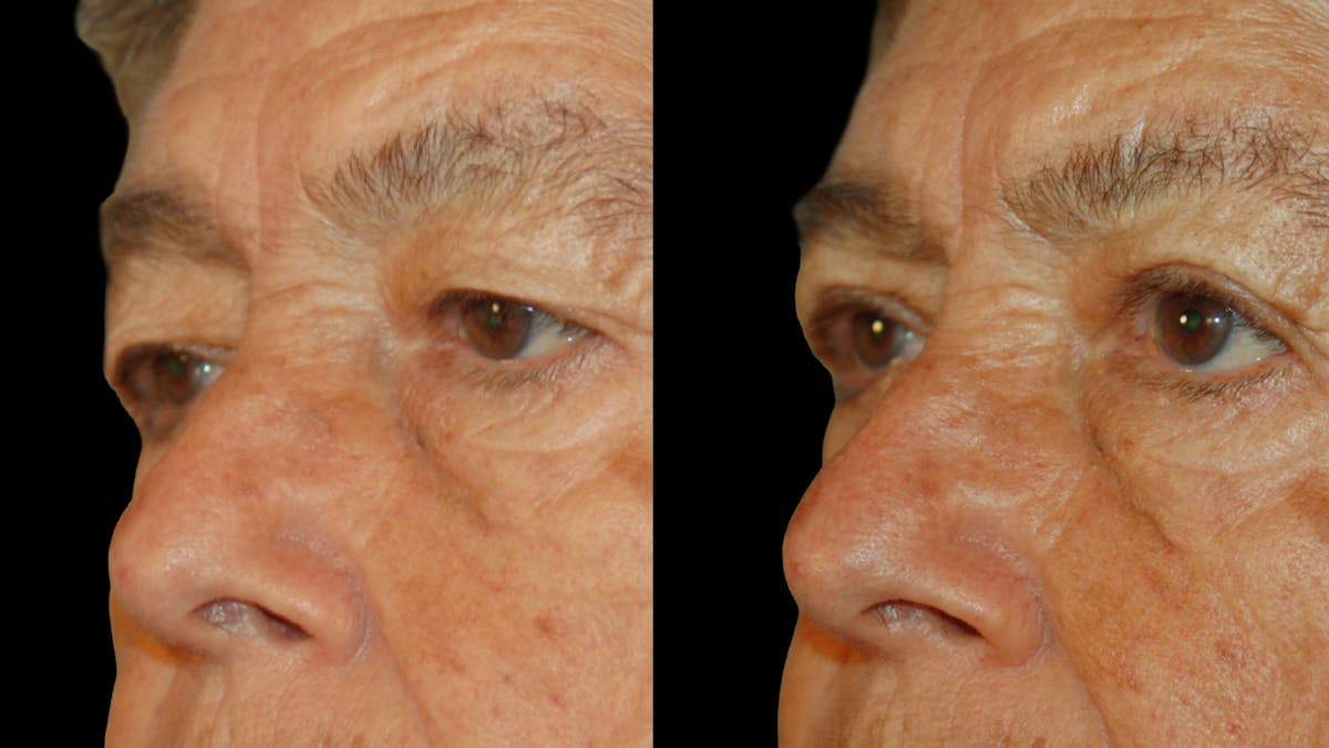 Upper Eyelid Surgery Before & After Gallery - Patient 159746 - Image 3