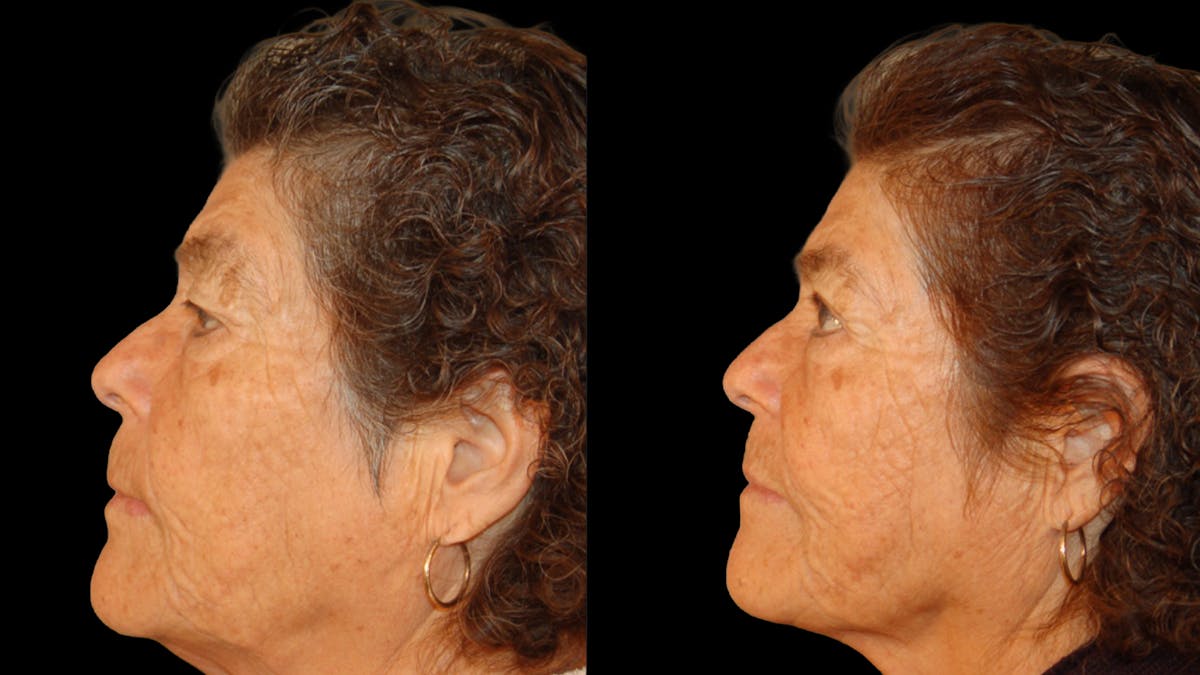 Upper Eyelid Surgery Before & After Gallery - Patient 159746 - Image 4