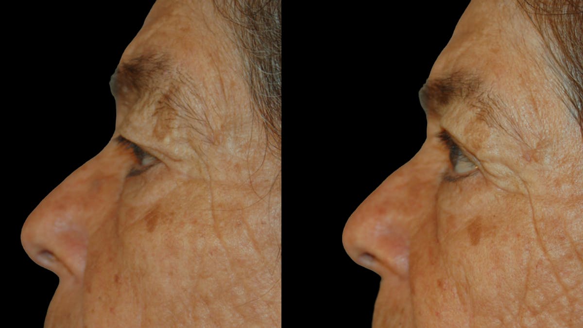 Upper Eyelid Surgery Before & After Gallery - Patient 159746 - Image 5