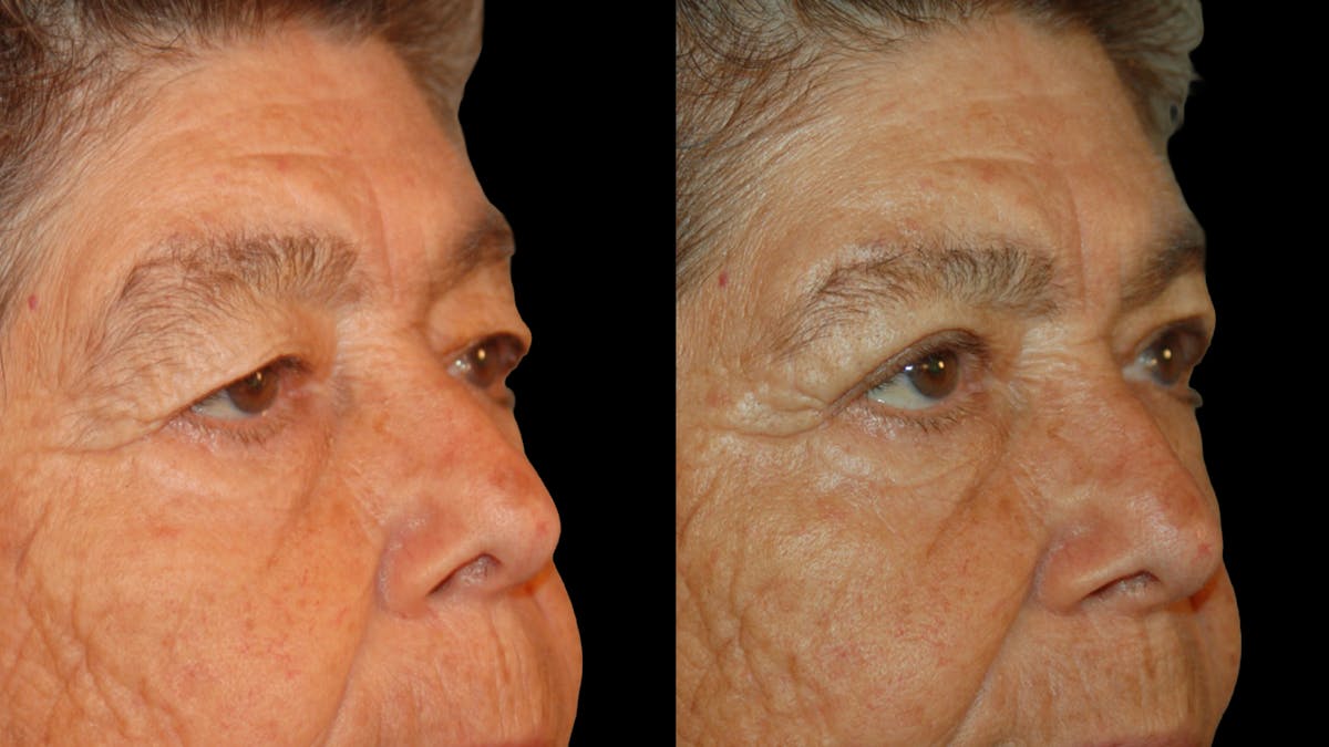Upper Eyelid Surgery Before & After Gallery - Patient 159746 - Image 7