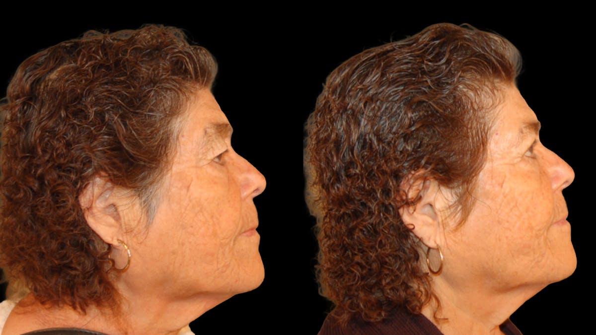 Upper Eyelid Surgery Before & After Gallery - Patient 159746 - Image 8