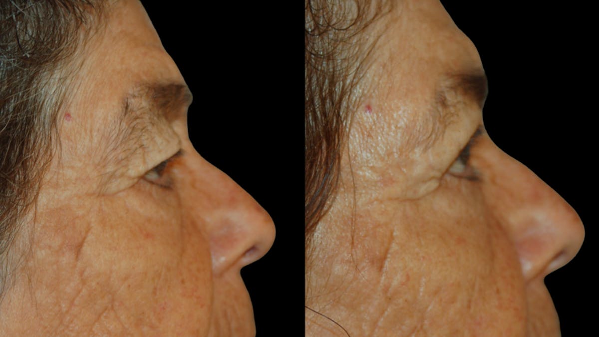 Upper Eyelid Surgery Before & After Gallery - Patient 159746 - Image 9