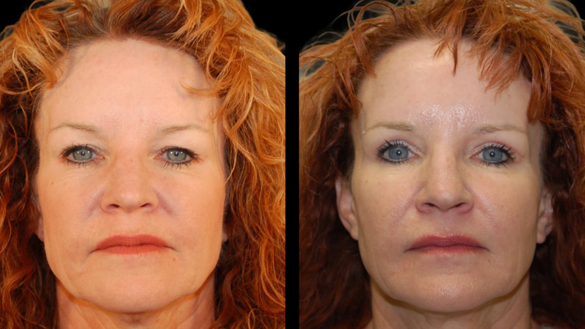 Upper Eyelid Surgery Before & After Gallery - Patient 193920 - Image 1
