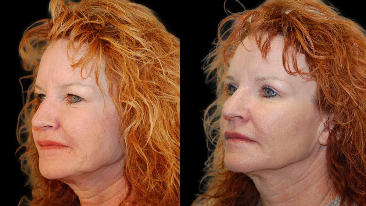 Upper Eyelid Surgery Before & After Gallery - Patient 193920 - Image 2
