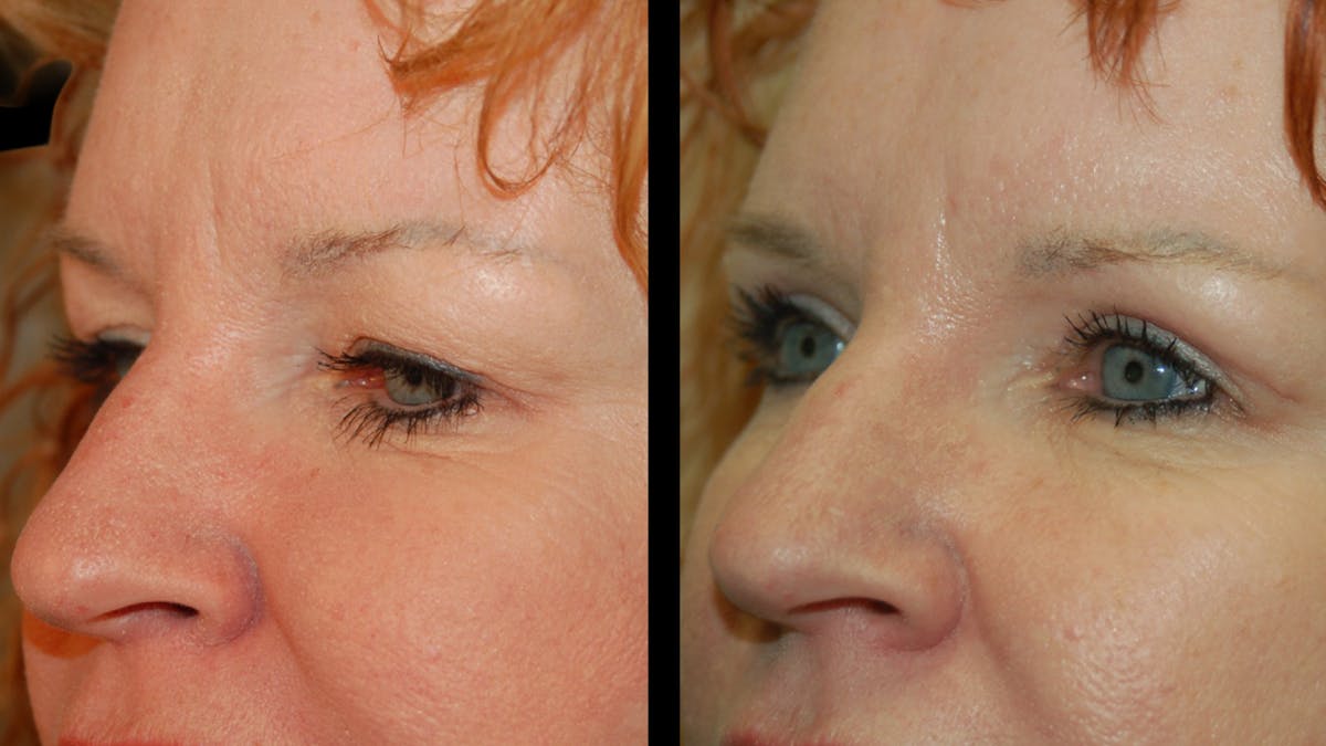 Upper Eyelid Surgery Before & After Gallery - Patient 193920 - Image 3