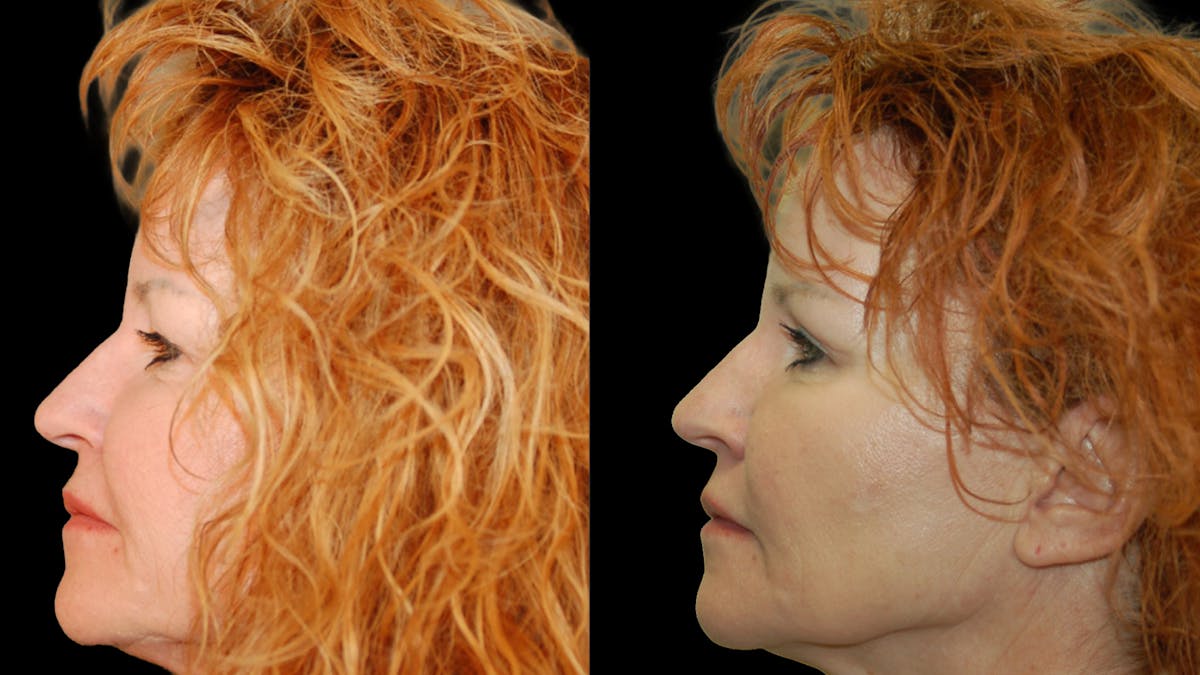 Upper Eyelid Surgery Before & After Gallery - Patient 193920 - Image 4