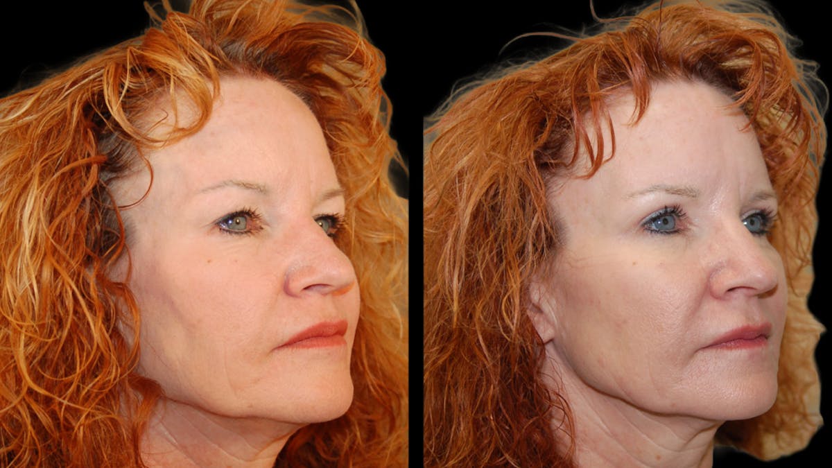 Upper Eyelid Surgery Before & After Gallery - Patient 193920 - Image 6