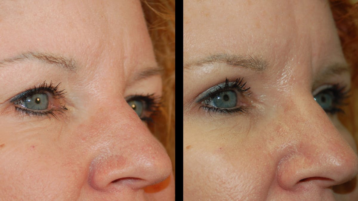 Upper Eyelid Surgery Before & After Gallery - Patient 193920 - Image 7