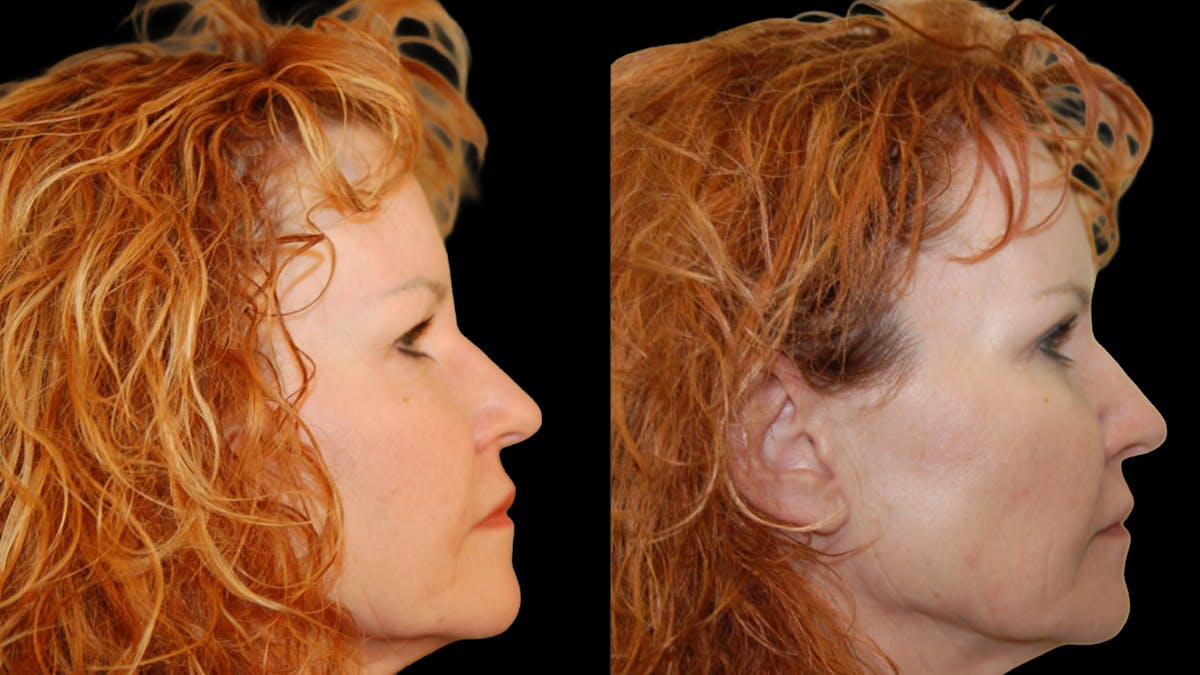 Upper Eyelid Surgery Before & After Gallery - Patient 193920 - Image 8