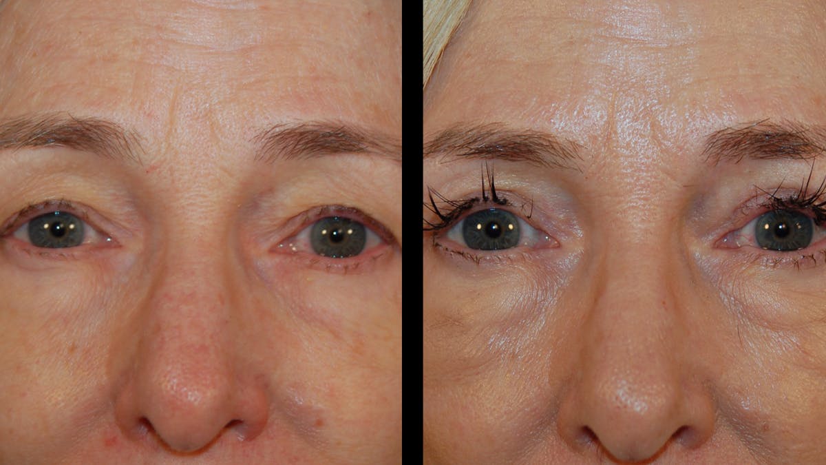 Upper Eyelid Surgery Before & After Gallery - Patient 258218 - Image 10