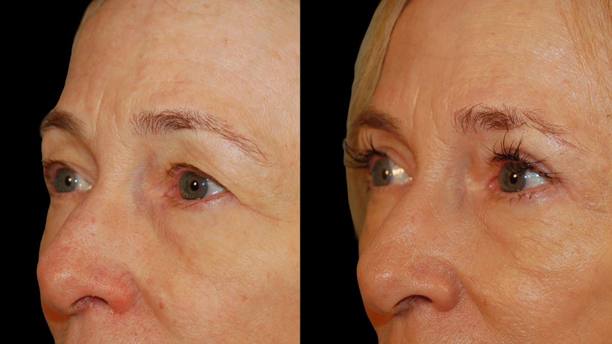 Upper Eyelid Surgery Before & After Gallery - Patient 258218 - Image 2