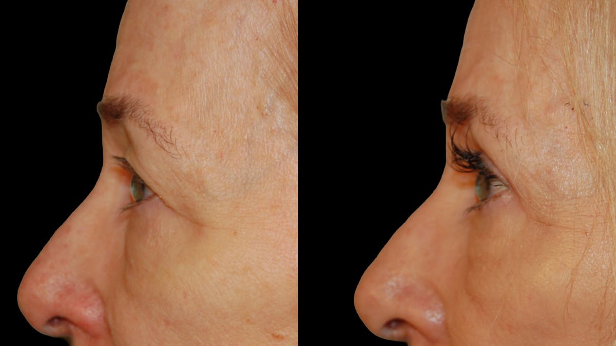 Upper Eyelid Surgery Before & After Gallery - Patient 258218 - Image 3