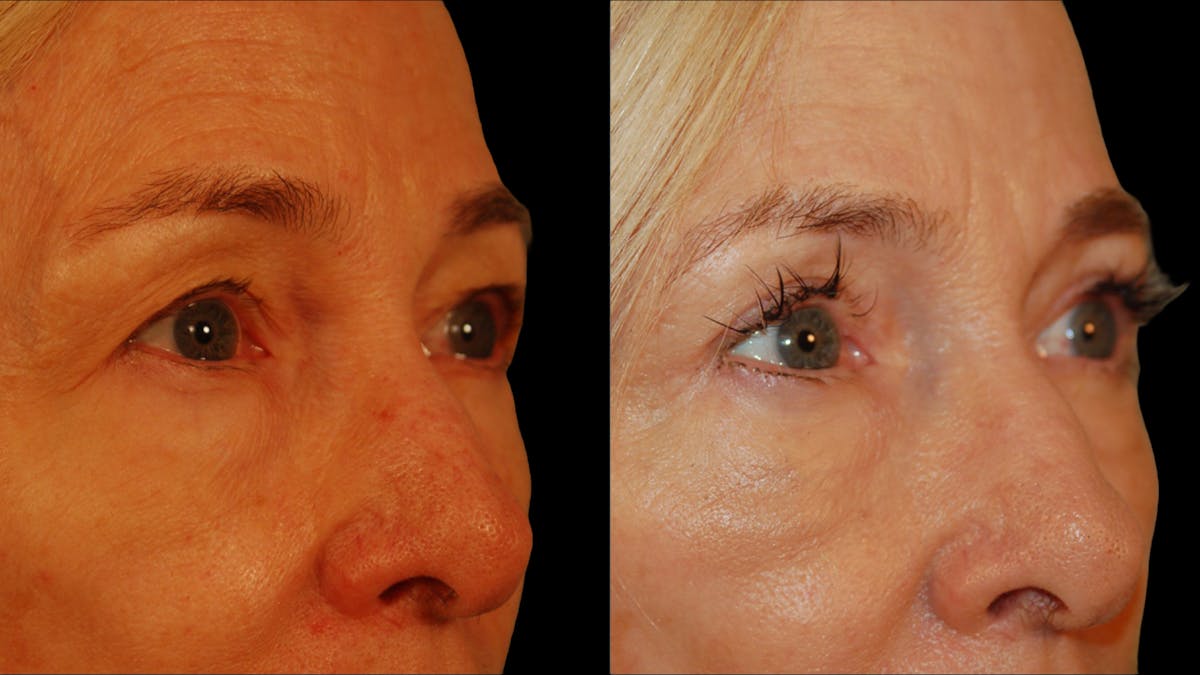 Upper Eyelid Surgery Before & After Gallery - Patient 258218 - Image 4
