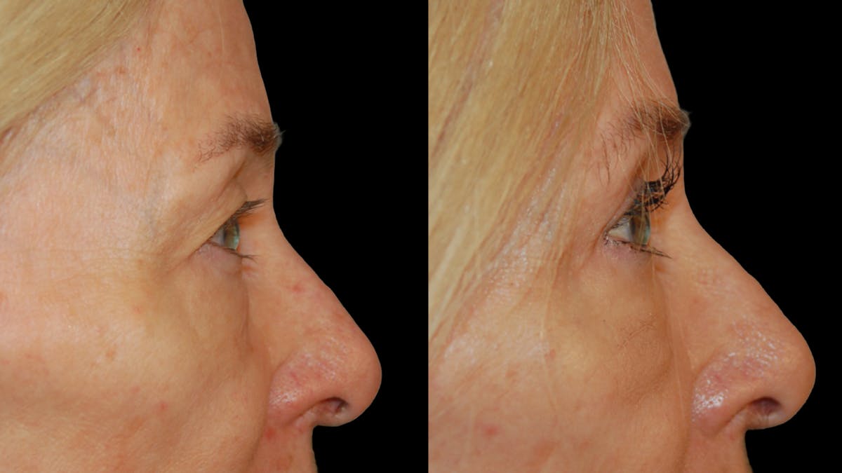 Upper Eyelid Surgery Before & After Gallery - Patient 258218 - Image 5