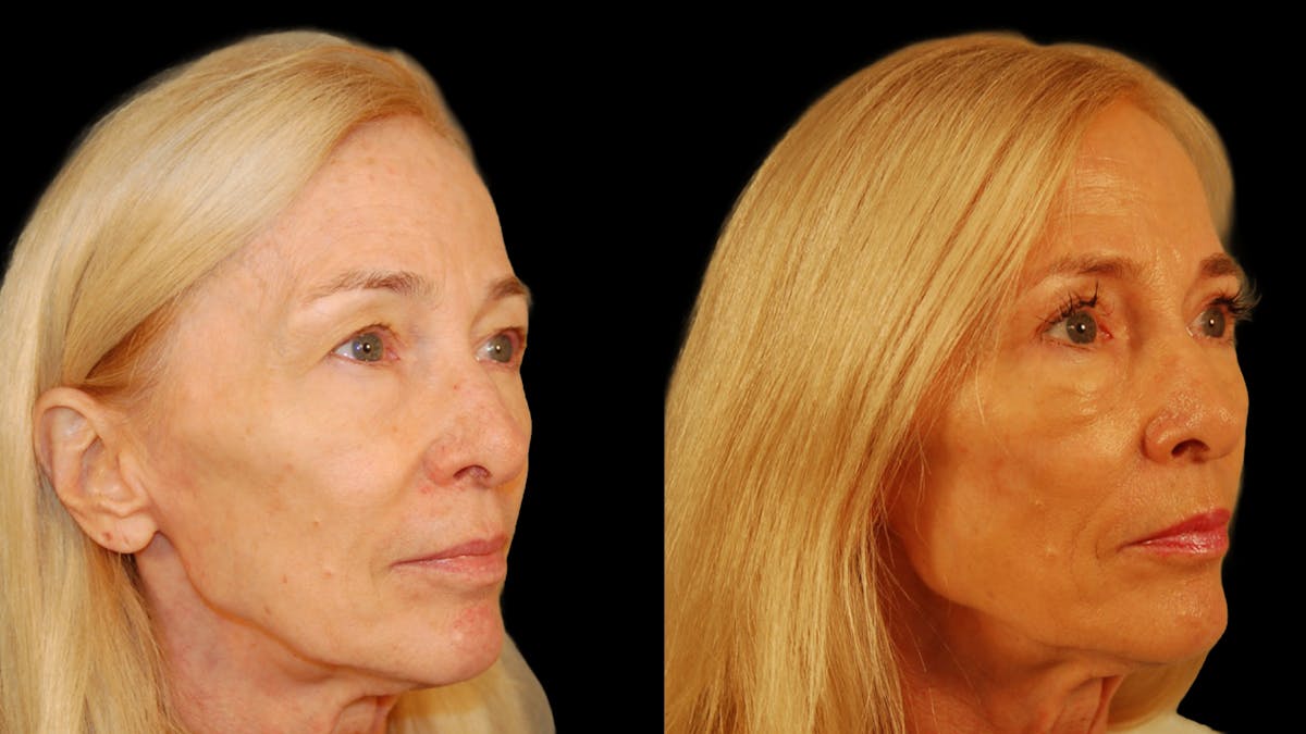 Upper Eyelid Surgery Before & After Gallery - Patient 258218 - Image 6