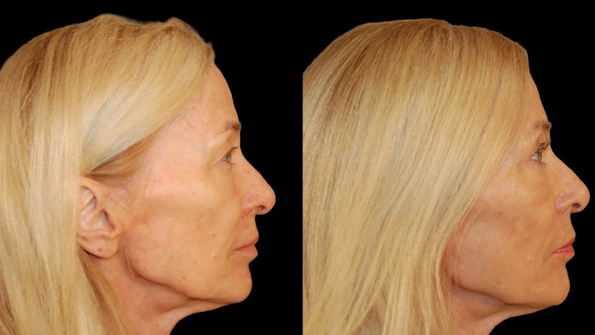 Upper Eyelid Surgery Before & After Gallery - Patient 258218 - Image 7