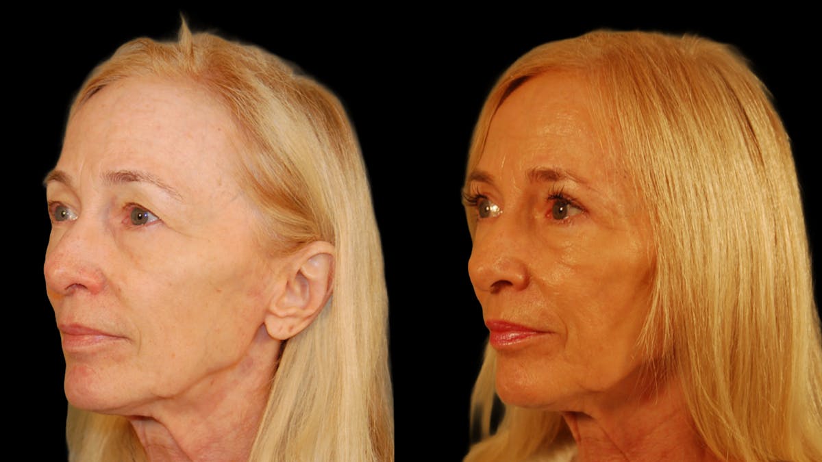 Upper Eyelid Surgery Before & After Gallery - Patient 258218 - Image 8