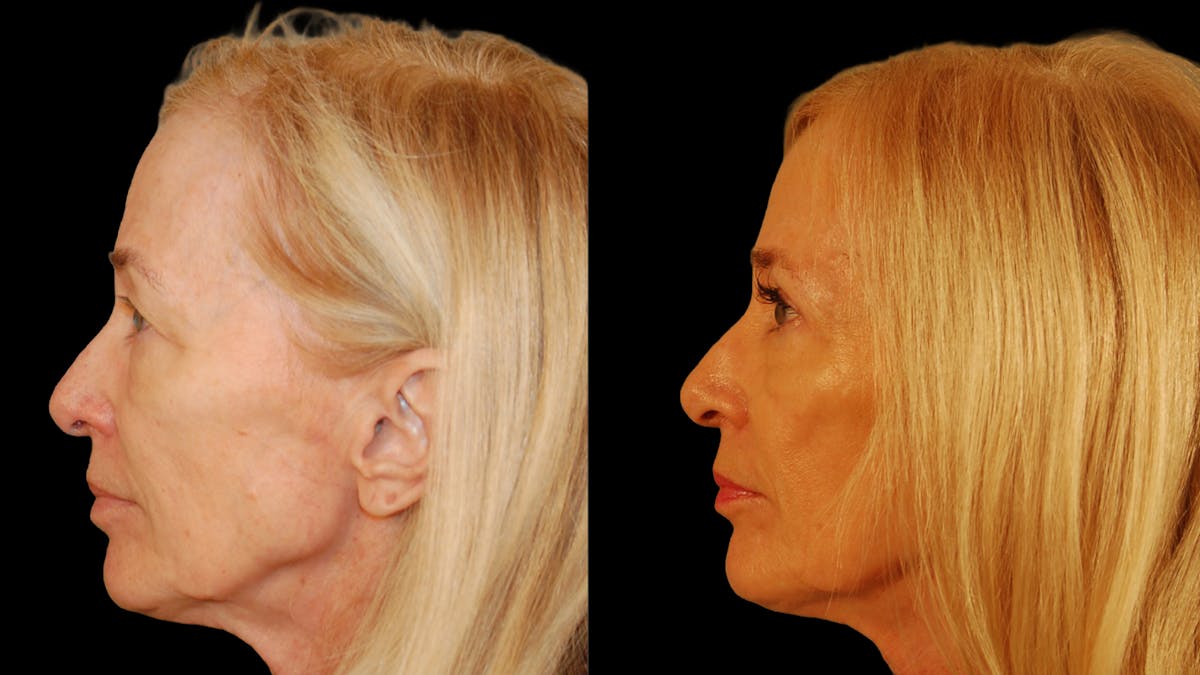 Upper Eyelid Surgery Before & After Gallery - Patient 258218 - Image 9
