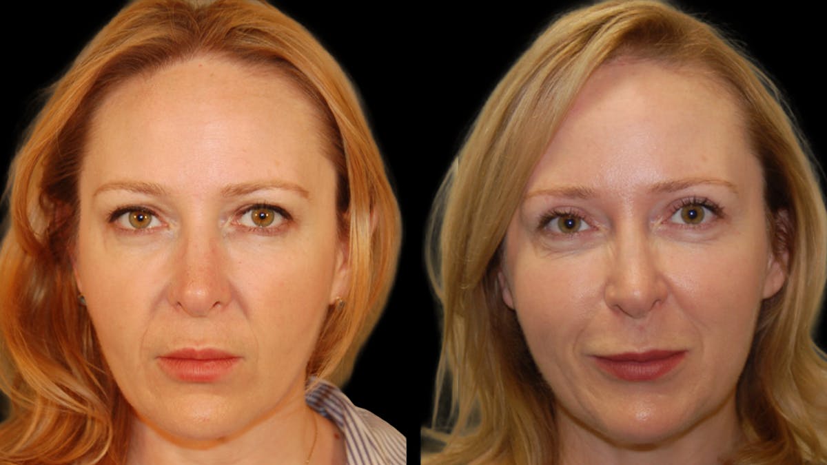 Upper Eyelid Surgery Before & After Gallery - Patient 278670 - Image 1