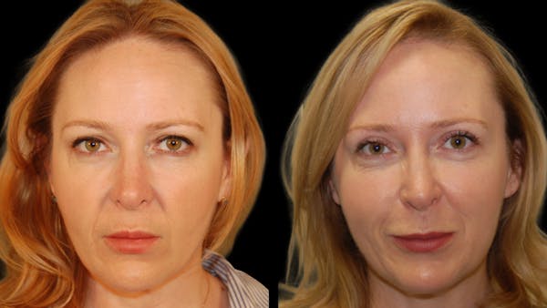 Upper Eyelid Surgery Before & After Gallery - Patient 278670 - Image 1