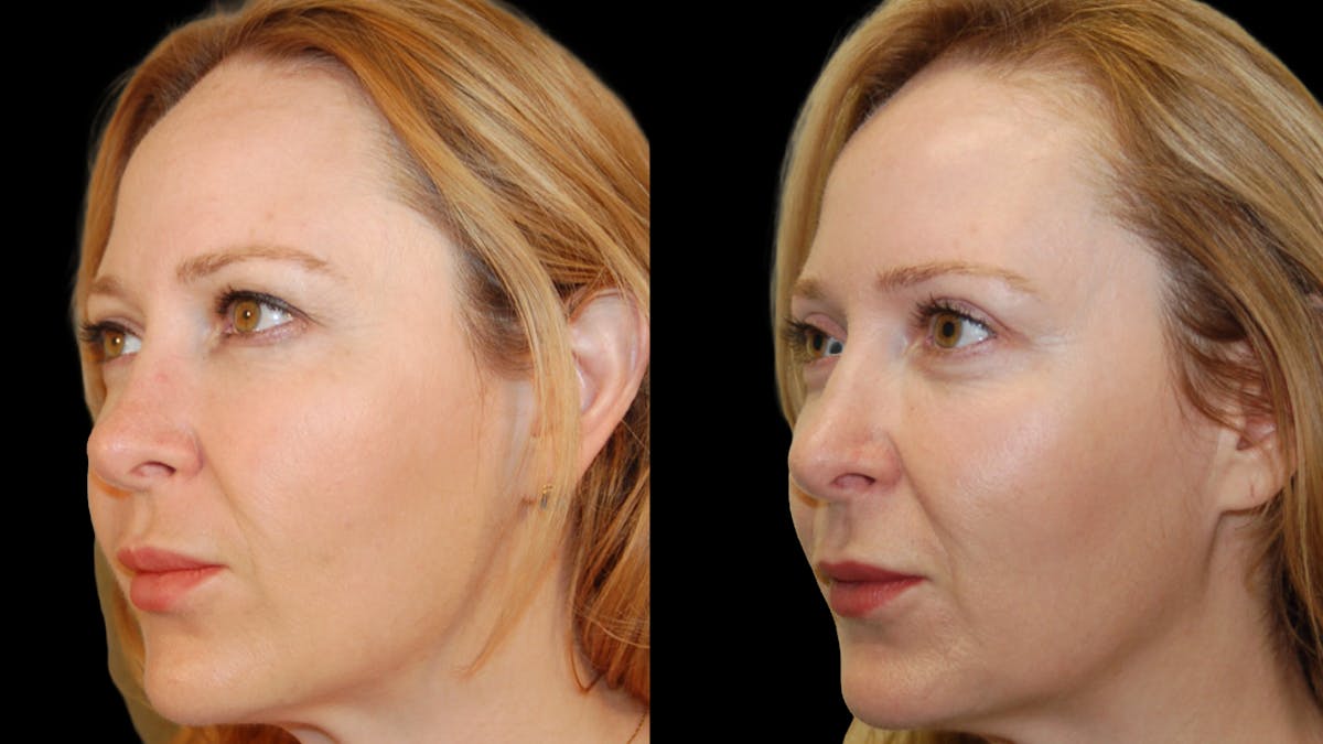 Upper Eyelid Surgery Before & After Gallery - Patient 278670 - Image 3