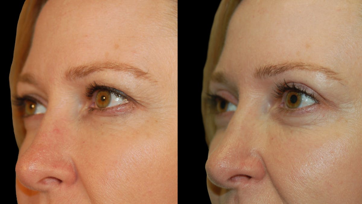 Upper Eyelid Surgery Before & After Gallery - Patient 278670 - Image 4