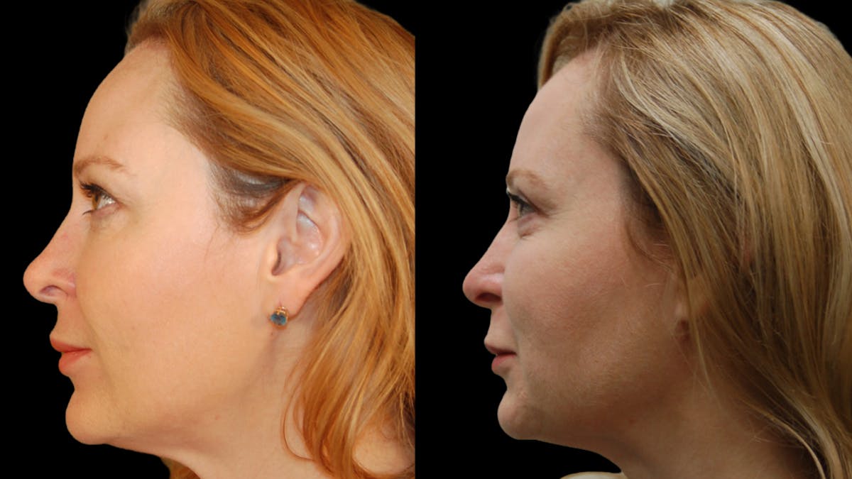 Upper Eyelid Surgery Before & After Gallery - Patient 278670 - Image 5
