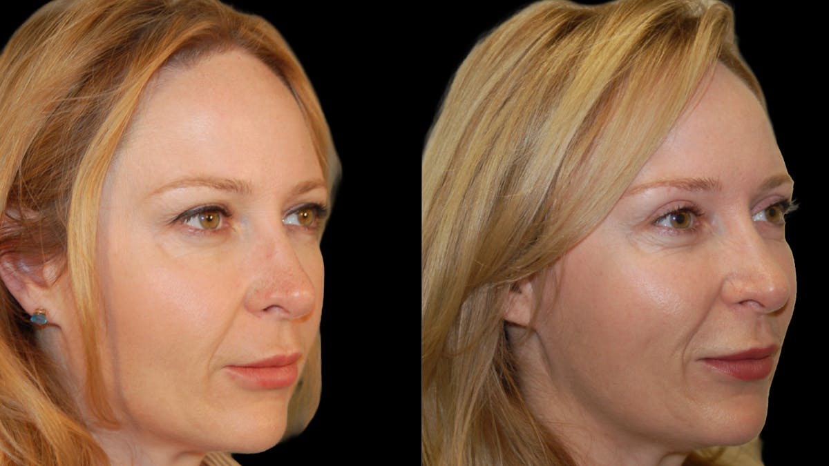 Upper Eyelid Surgery Before & After Gallery - Patient 278670 - Image 7