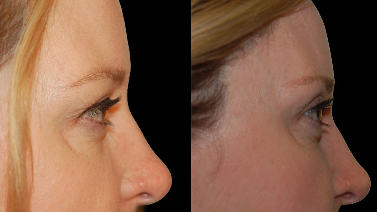 Upper Eyelid Surgery Before & After Gallery - Patient 278670 - Image 9