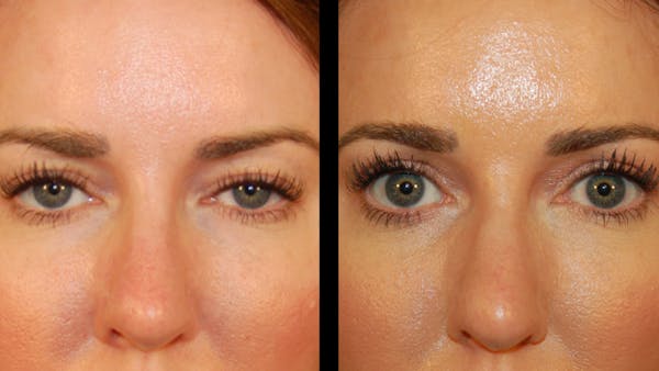 Upper Eyelid Surgery Before & After Gallery - Patient 286040 - Image 1