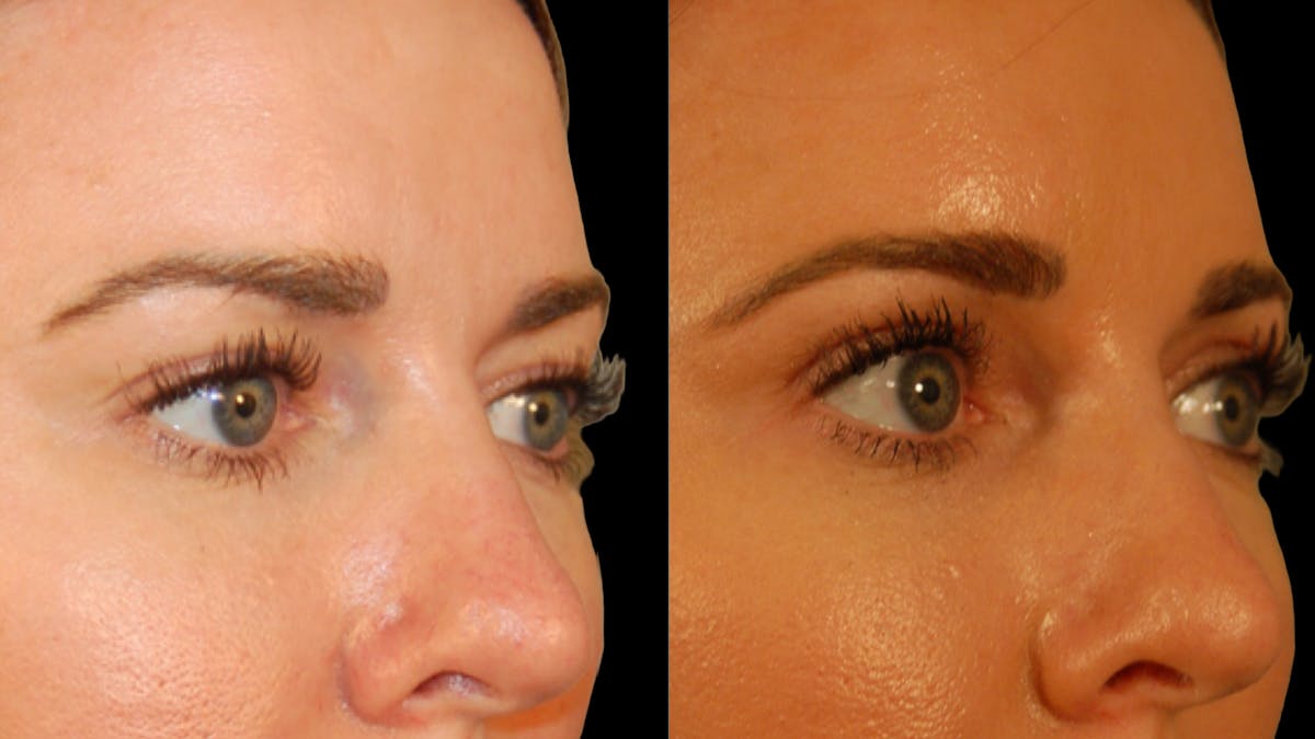 Upper Eyelid Surgery Before & After Gallery - Patient 286040 - Image 2