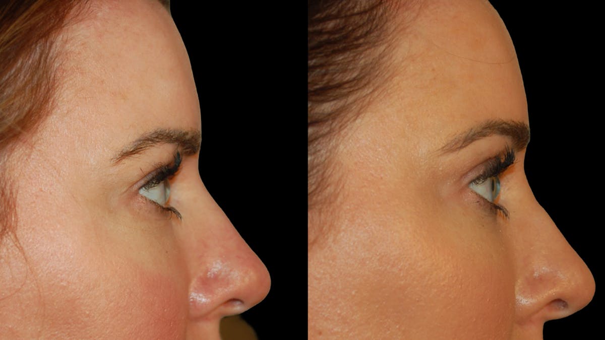 Upper Eyelid Surgery Before & After Gallery - Patient 286040 - Image 3