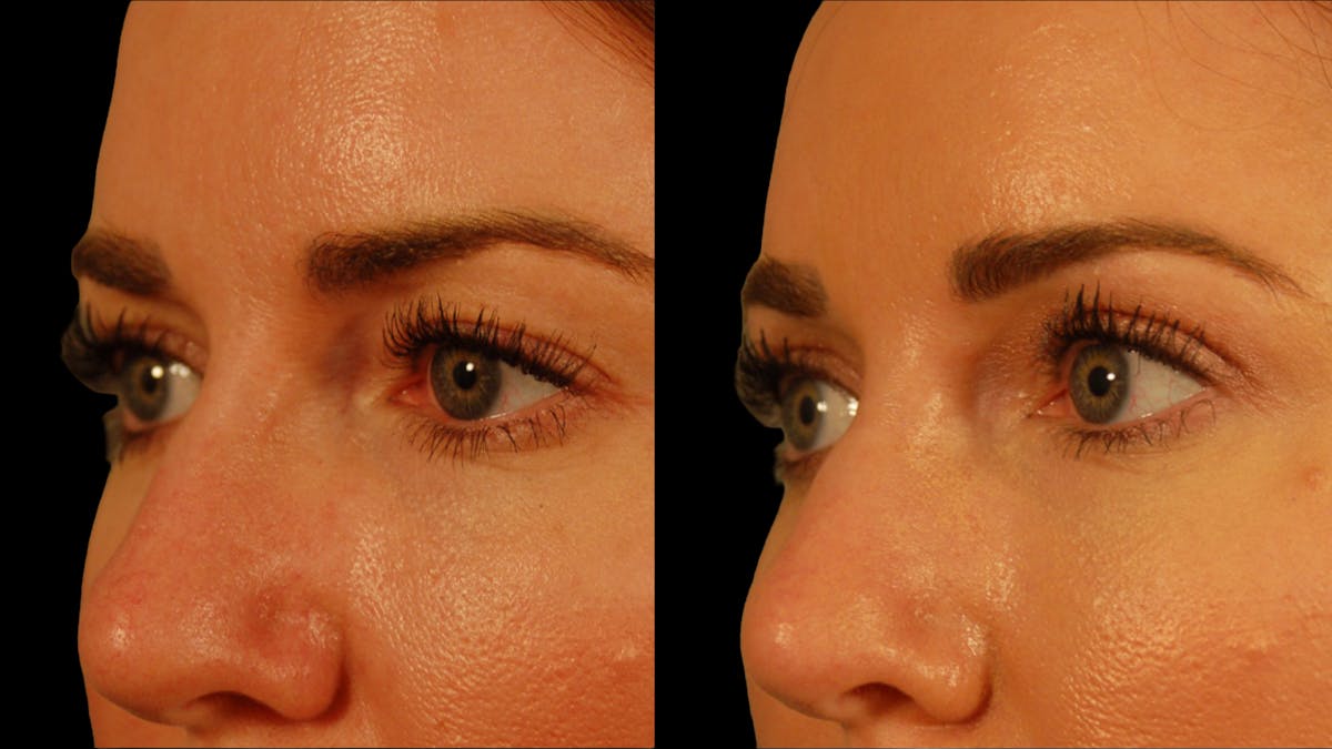 Upper Eyelid Surgery Before & After Gallery - Patient 286040 - Image 4