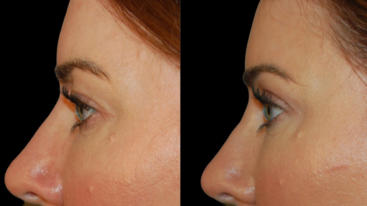 Upper Eyelid Surgery Before & After Gallery - Patient 286040 - Image 5