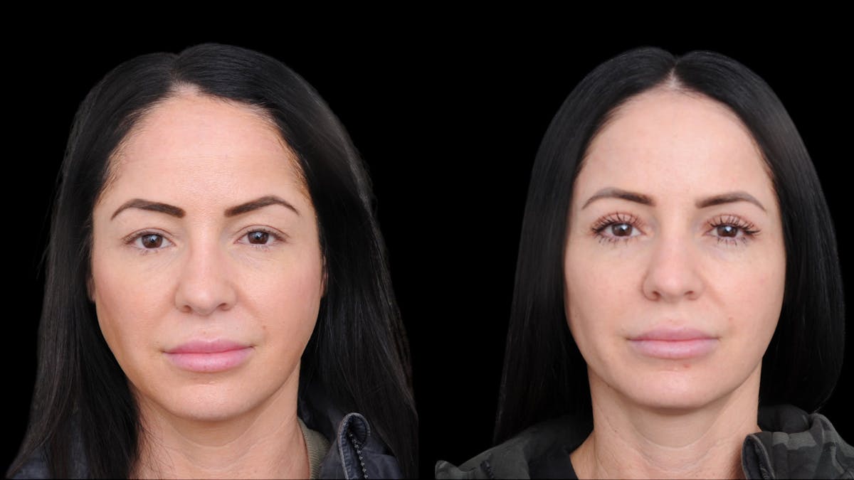 Upper Eyelid Surgery Before & After Gallery - Patient 772450 - Image 1