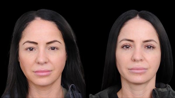 Upper Eyelid Surgery Before & After Gallery - Patient 772450 - Image 1