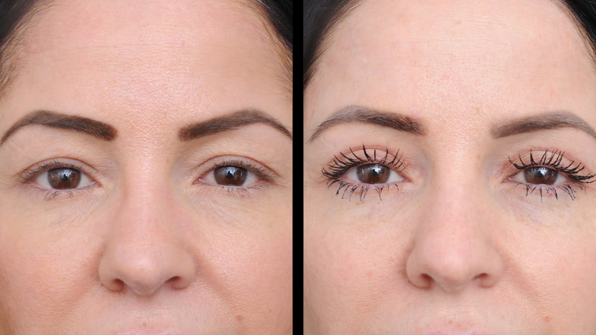 Upper Eyelid Surgery Before & After Gallery - Patient 772450 - Image 2