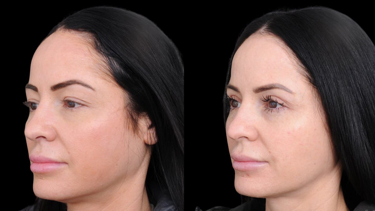 Upper Eyelid Surgery Before & After Gallery - Patient 772450 - Image 3