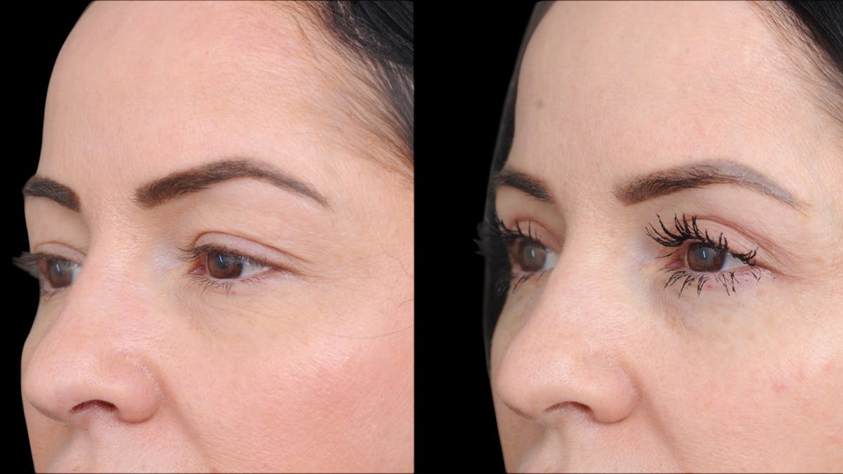 Upper Eyelid Surgery Before & After Gallery - Patient 772450 - Image 4