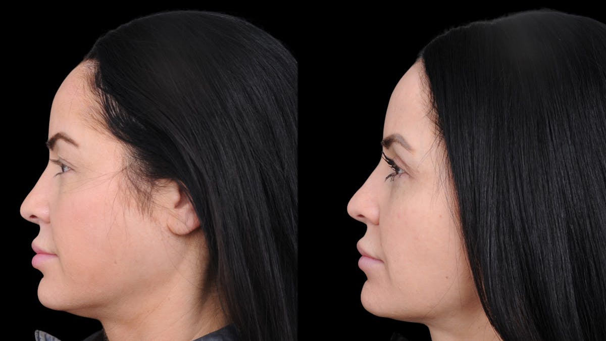 Upper Eyelid Surgery Before & After Gallery - Patient 772450 - Image 5