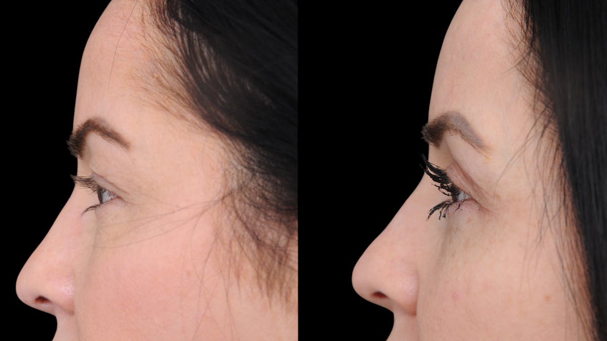 Upper Eyelid Surgery Before & After Gallery - Patient 772450 - Image 6