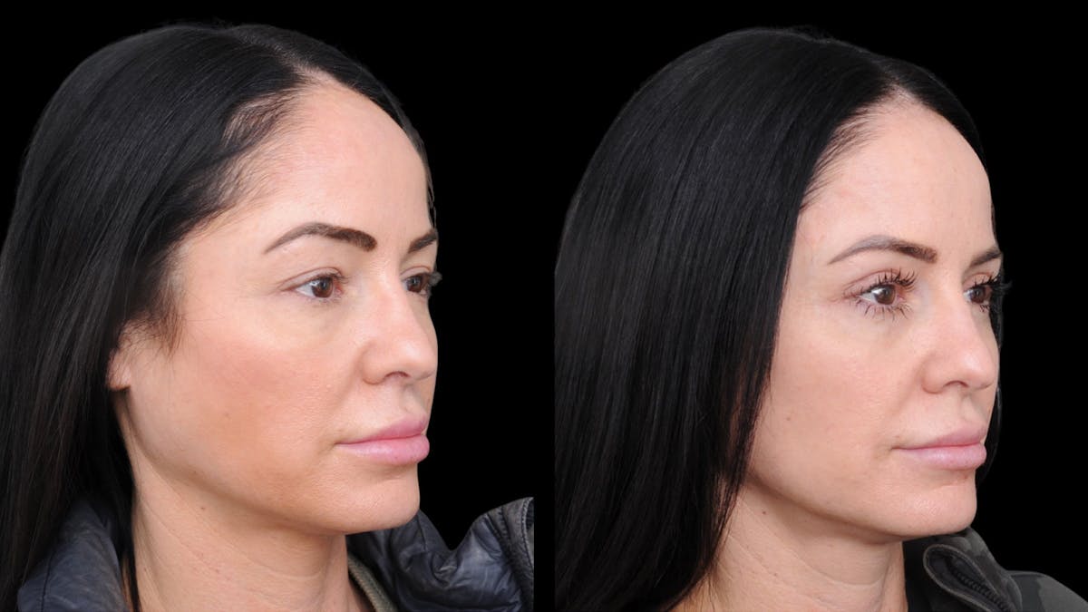 Upper Eyelid Surgery Before & After Gallery - Patient 772450 - Image 7