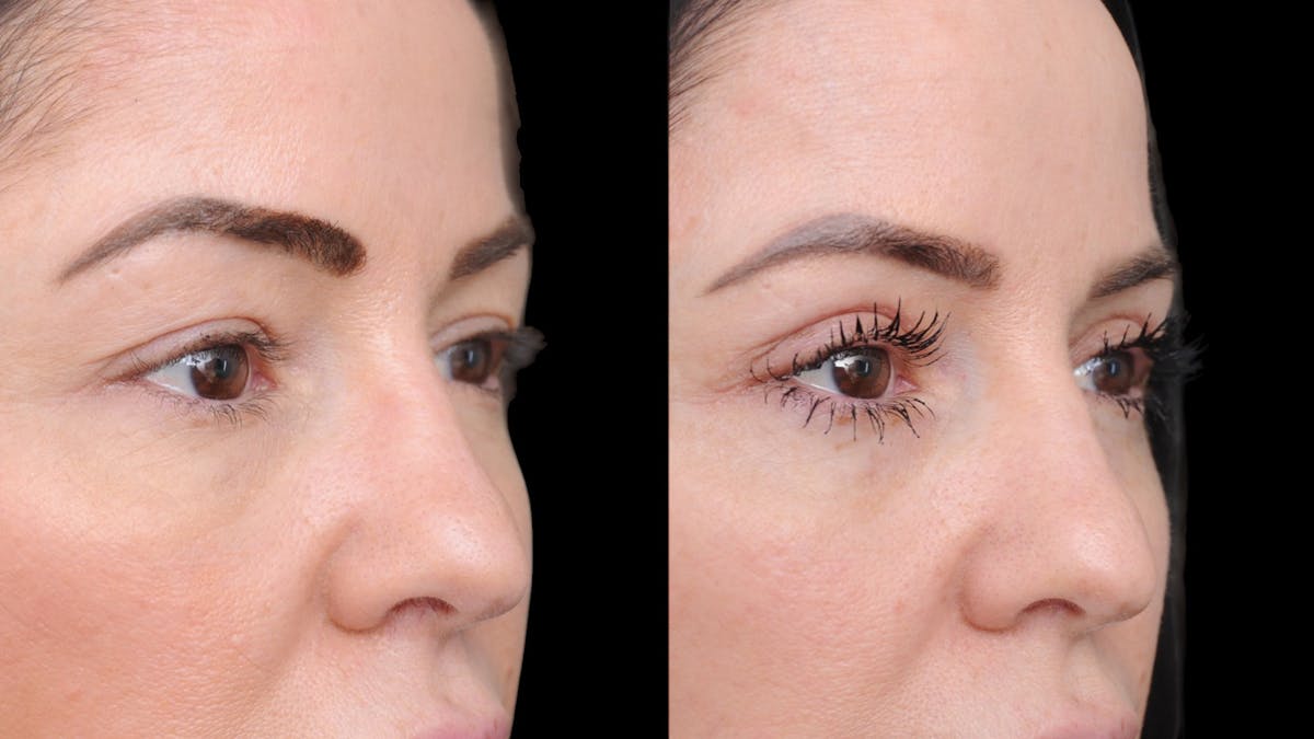 Upper Eyelid Surgery Before & After Gallery - Patient 772450 - Image 8