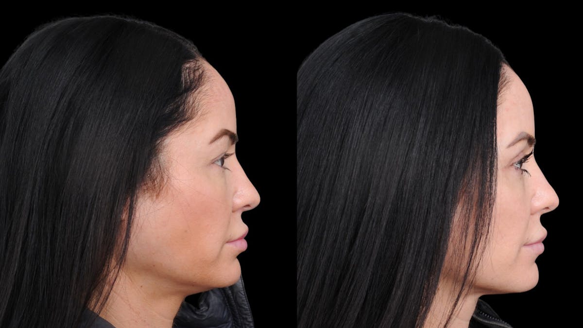 Upper Eyelid Surgery Before & After Gallery - Patient 772450 - Image 9