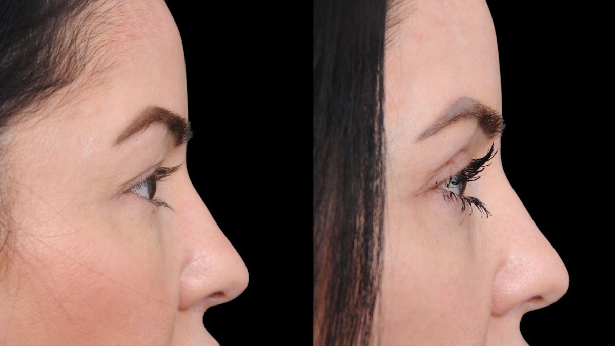 Upper Eyelid Surgery Before & After Gallery - Patient 772450 - Image 10
