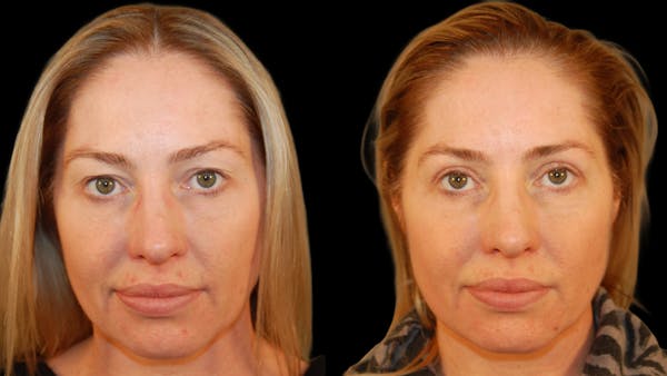 Upper Eyelid Surgery Before & After Gallery - Patient 419026 - Image 1