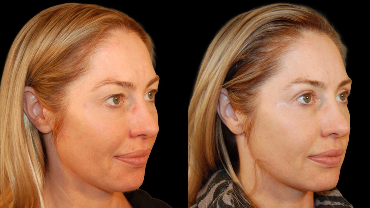 Upper Eyelid Surgery Before & After Gallery - Patient 419026 - Image 2